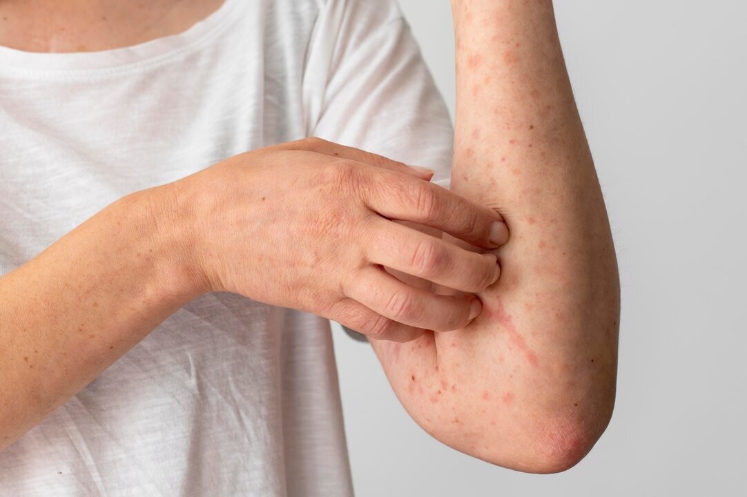 Measles Outbreak in South Carolina: Over 250 People Quarantined