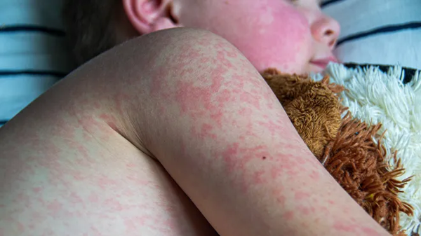 Increase in Measles Cases in Texas